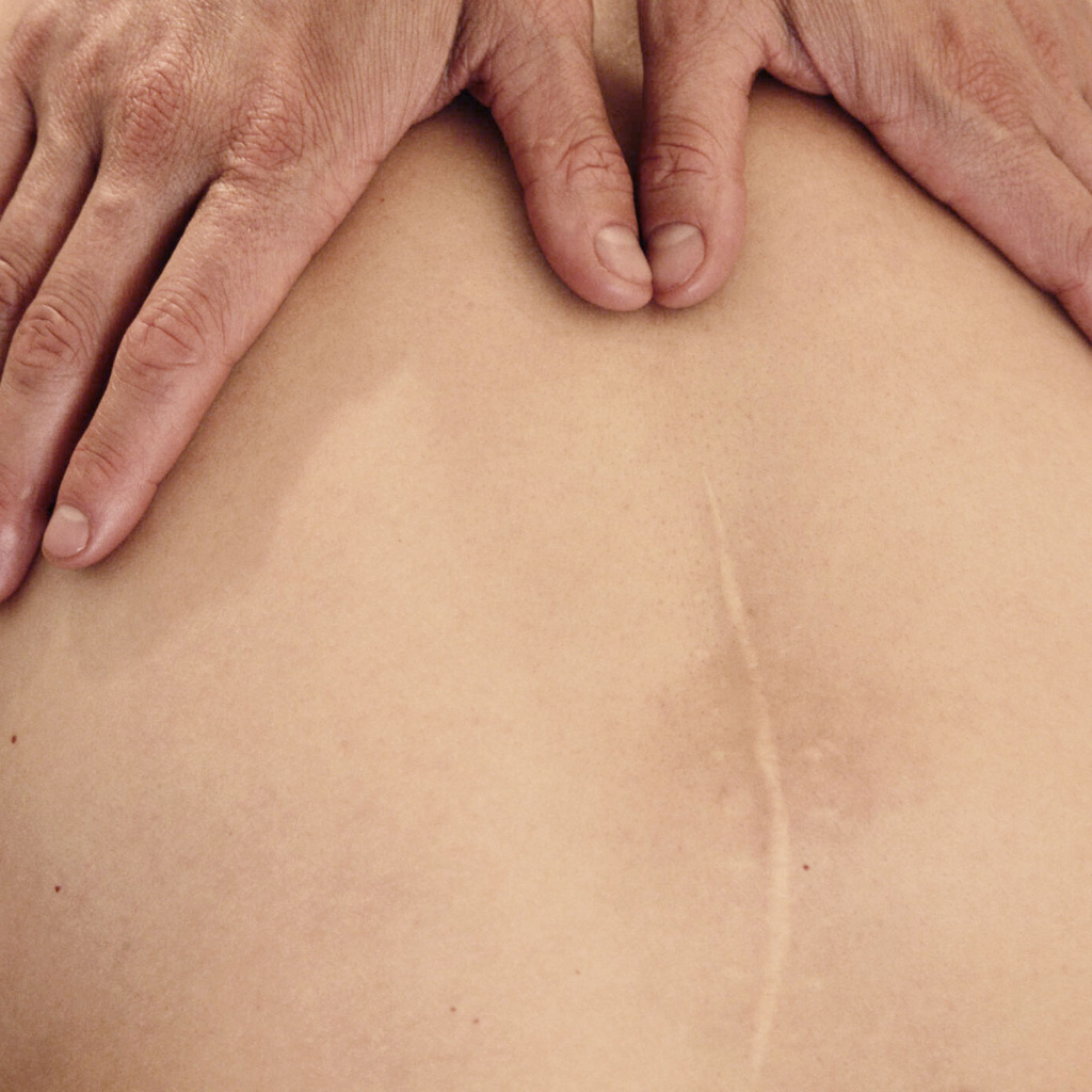 Scar Massage